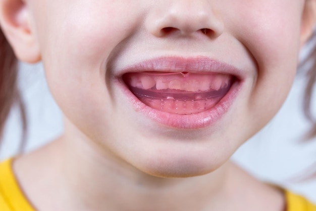 Sixyear old caucasian girl shows myofunctional trainer in her mouth