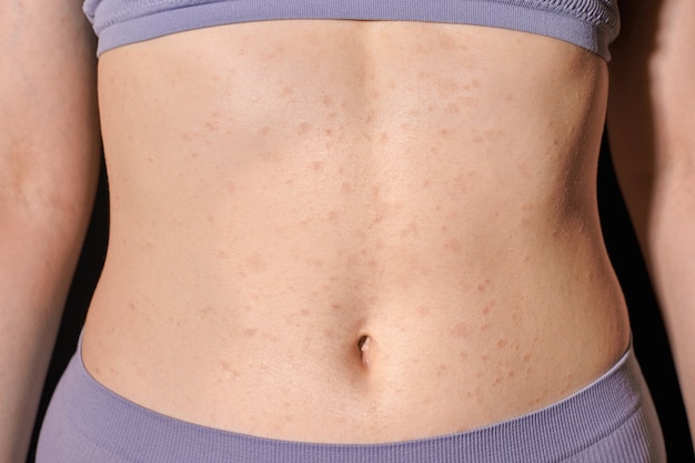 Premium Photo  Female torso with red allergic rash on stomach