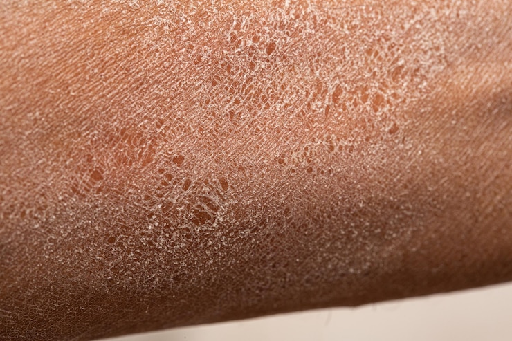Photo skin care concept of prevention of dry skin in the tanned subject