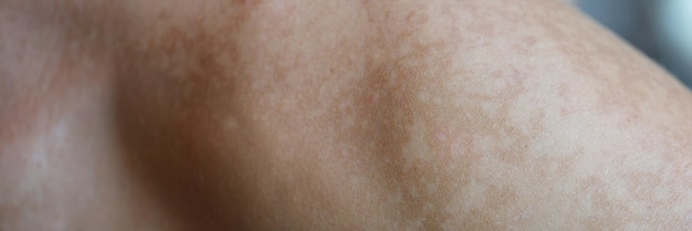 Photo skin care problem spots on shoulder skin and health concept melasma pigment spots dry skin