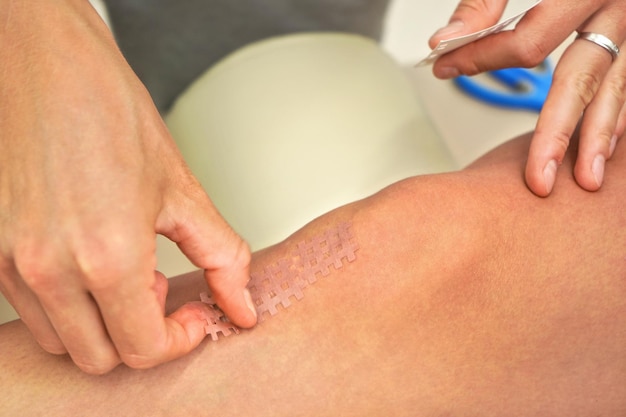 Skin coloured kinesiology grid tape applied on knee of patient, closeup detail