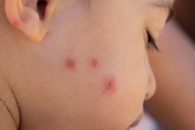 Photo skin irritation caused by insect bites on the face of a newborn