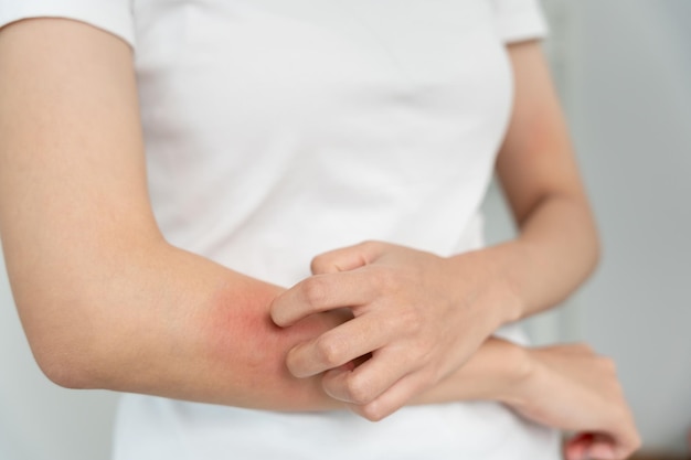 skin problem and beauty Young woman scratch body has itchy skin from skin allergic steroid allergy sensitive skin red from sunburn chemical allergy rash insect bites Seborrheic Dermatitis