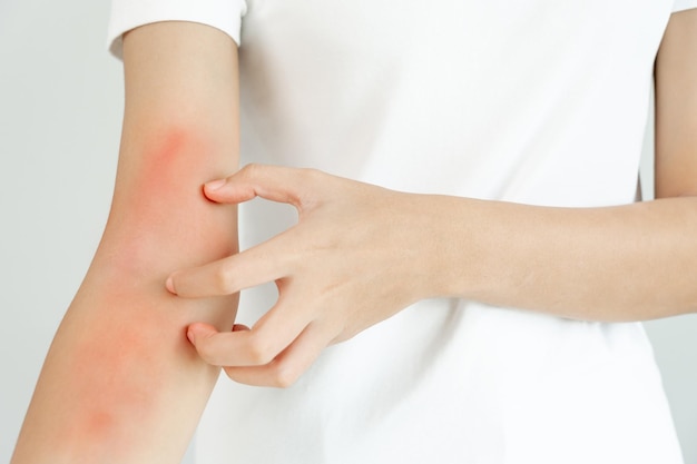 skin problem and beauty young woman scratch body has itchy skin from skin allergic steroid allergy sensitive skin red from sunburn chemical allergy rash insect bites seborrheic dermatitis