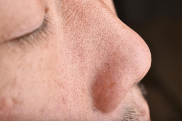 Foto problema della pelle con rughe e pigmentazione, viso ravvicinato con acne e pelle secca, pori grandi e viso grasso e grasso, concetto di bellezza.