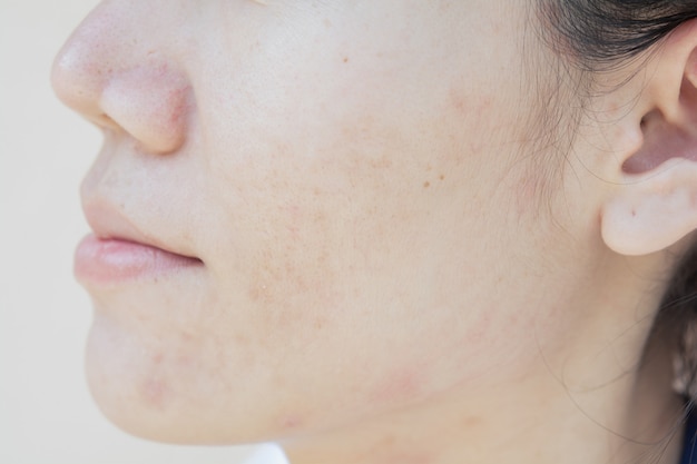 Problemi di pelle e macchie scure. cicatrice da acne sul viso