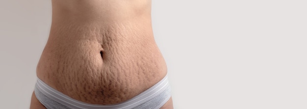 Skin stretch marks on female belly