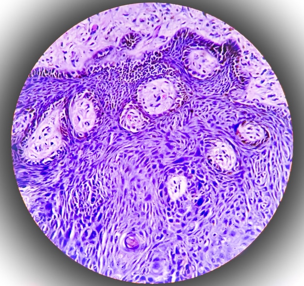 Photo skin tissue biopsy lichen planus. show skin tissue, hyperplastic squamous epithelium cells