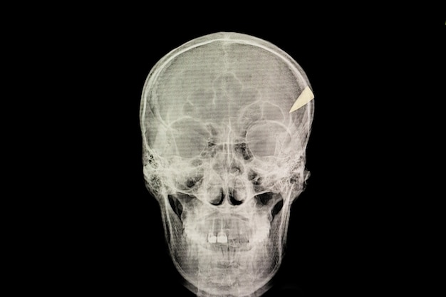 사진 두개골 침투 부상