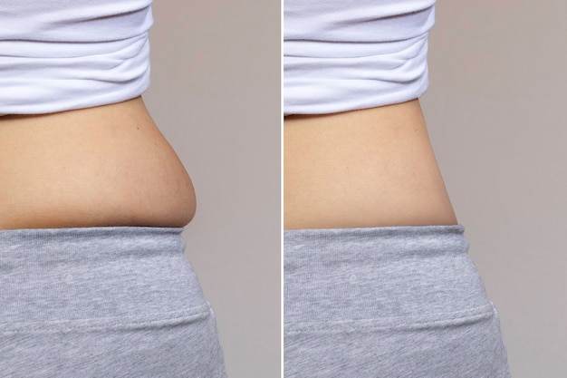 Slim and fat female side belly comparison