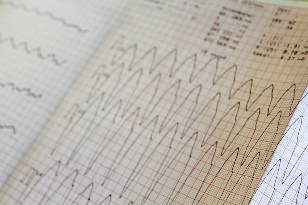 Foto sluit omhoog mening van een elektrocardiogramdocument.