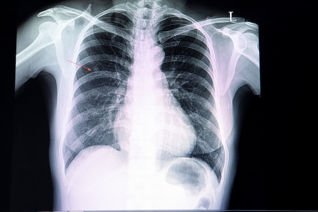 Small nodule  in the lung