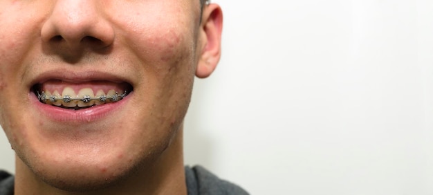 Sorriso con bretelle trattamento ortodontico concetto di cure odontoiatriche