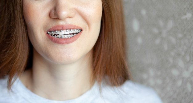 Il sorriso di una giovane e bella ragazza con l'apparecchio sui denti bianchi. raddrizzamento dei denti storti con l'aiuto di un sistema di staffe. malocclusione. cure odontoiatriche. denti lisci e un bel sorriso