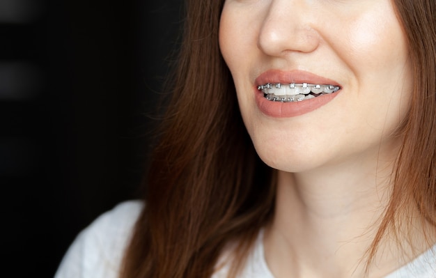 The smile of a young and beautiful girl with braces on her white teeth. Straightening of crooked teeth with the help of a bracket system. Malocclusion. Dental care. Smooth teeth and a beautiful smile