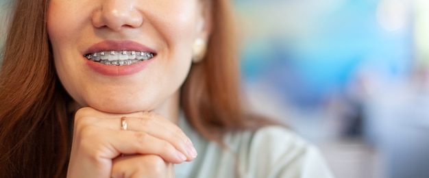 The smile of a young and beautiful girl with braces on her white teeth. Straightening of crooked teeth with the help of a bracket system. Malocclusion. Dental care. Smooth teeth and a beautiful smile