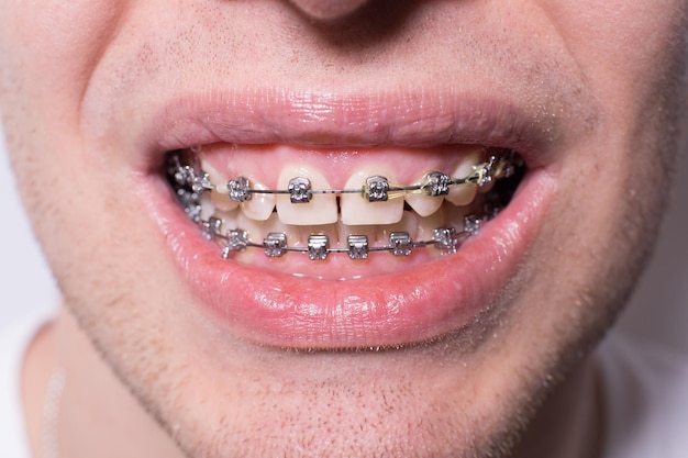 Smile of a young man in braces