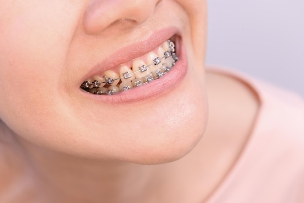 Smiling Asian woman wearing orthodontic retainer. Dental care and healthy teeth.