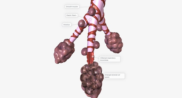 Smoking also affects the alveoli the tiny airfilled pockets in the lungs responsible for gas exchange and breathing