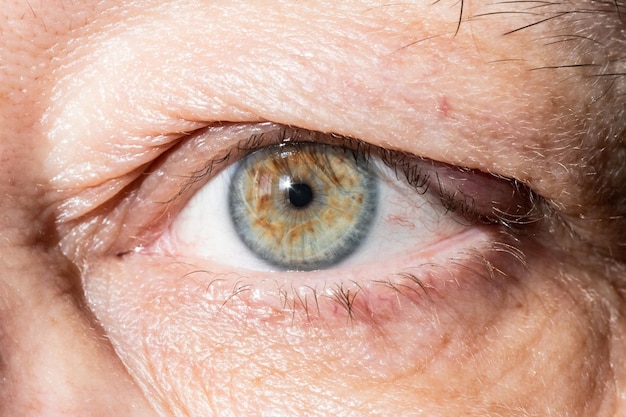 Photo sore eye with thickening on eyelid from chalazion