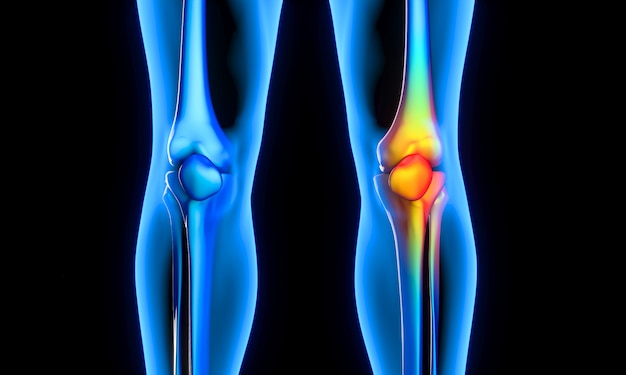 Sore knee in X-ray image