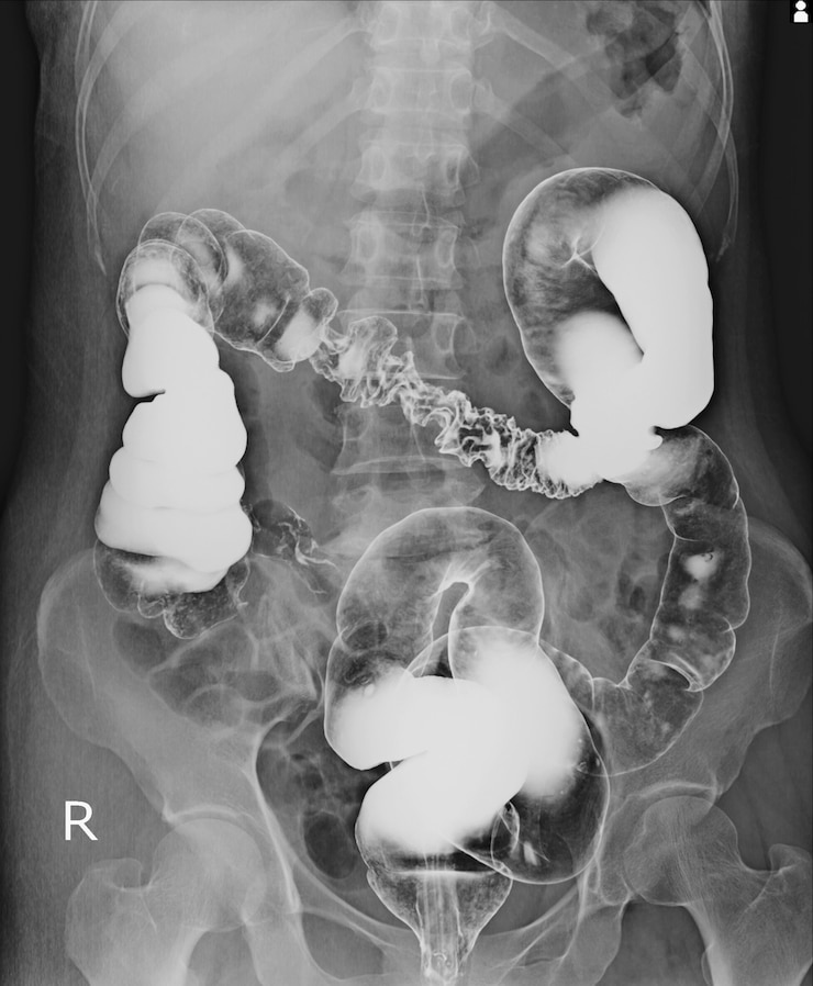 Photo special examination barium enema a female