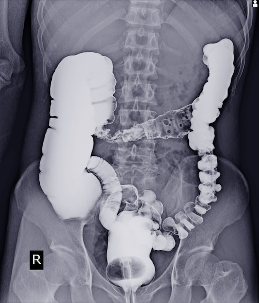 Special examination Barium enema