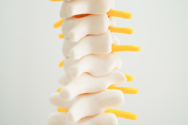 Spinal nerve and bone Lumbar spine displaced herniated disc fragment Model for treatment medical in the orthopedic department