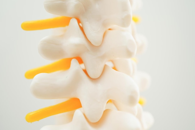 Spinal nerve and bone Lumbar spine displaced herniated disc fragment Model for treatment medical