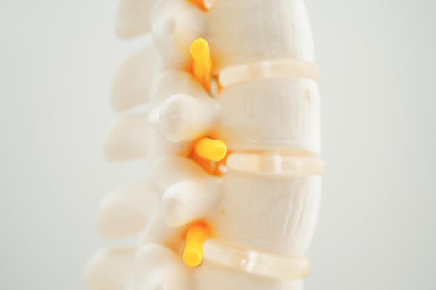 척수 신경 및  ⁇   ⁇ 간 척추 이탈 허리 디스크 조각 치료 모델 의료