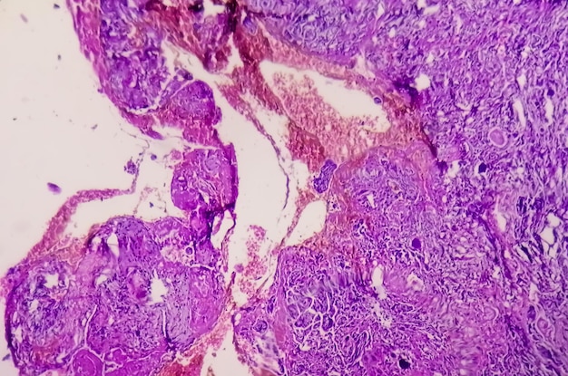 Spinal tumor biopsy showing Psammomatous meningioma. Psammoma bodies.