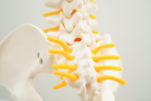 Spinale zenuw en bot Lumbale wervelkolom verplaatst herniafragment Model voor medische behandeling op de orthopedische afdeling