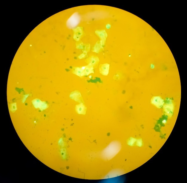 Мазок мокроты или мокроты КУМ, аурамин О и флуоресцентное окрашивание СИД. Микроскопия показывает эпителиальные клетки