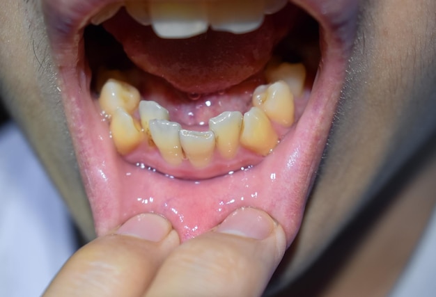 Stacked or overlapping teeth of Asian man Also called crowded teeth