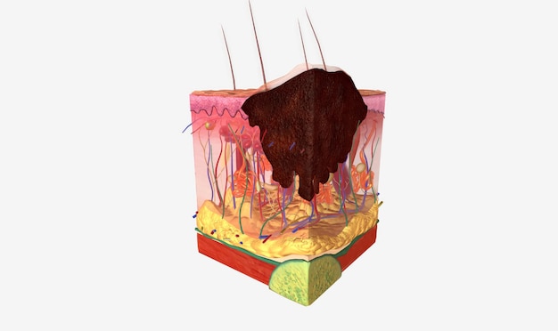 Photo the stage ii melanoma tumors