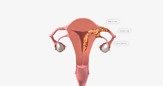 During stage III endometrial cancer the tumor spreads outside of the uterus