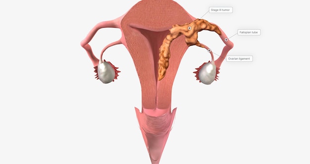 During stage III endometrial cancer the tumor spreads outside of the uterus