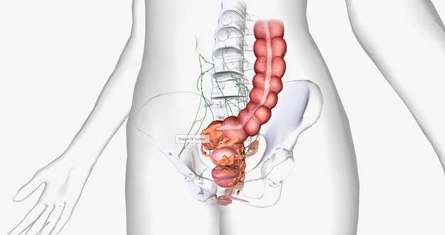 Stage IV cancer is characterized by the distant spread of the tumor outside the uterus