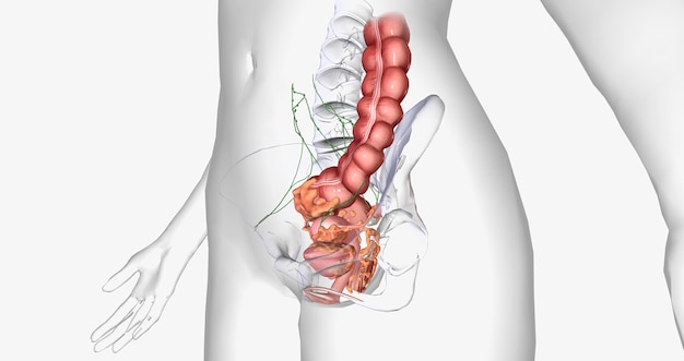 Stage IV cancer is characterized by the distant spread of the tumor outside the uterus