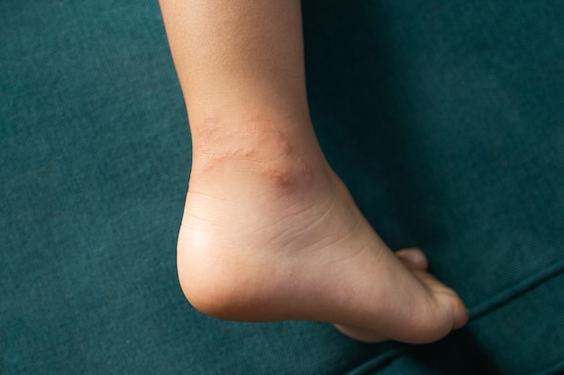 Sting of a jellyfish on the foot of a child