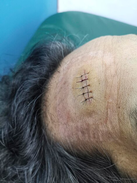 Photo stitched wound in forehead area from accident