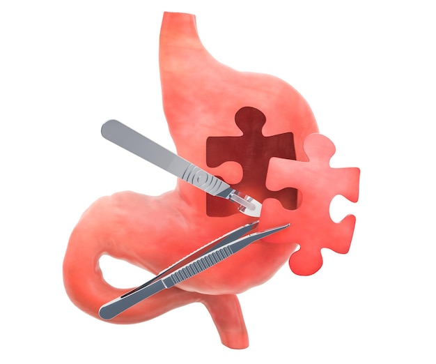 Stomach surgery concept 3D rendering