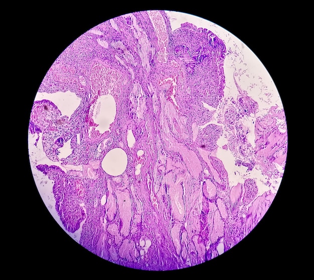 Stomach tissue biopsy under microscope show Adenomatous polyps or Stomach polyps or Gastric Polyps