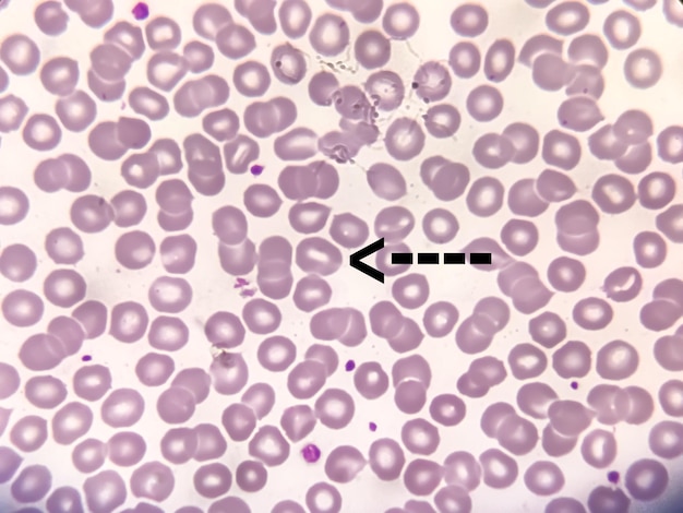 Stomatocyten geanalyseerd door microscoop. Rode bloedcellen zijn spleetachtig, vismond centrale bleekheid.