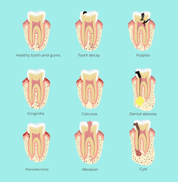 Stomatologie infografiek Tandheelkundige ziekten tandbederf pulpitis cyste gingivitis parodontitis Medic