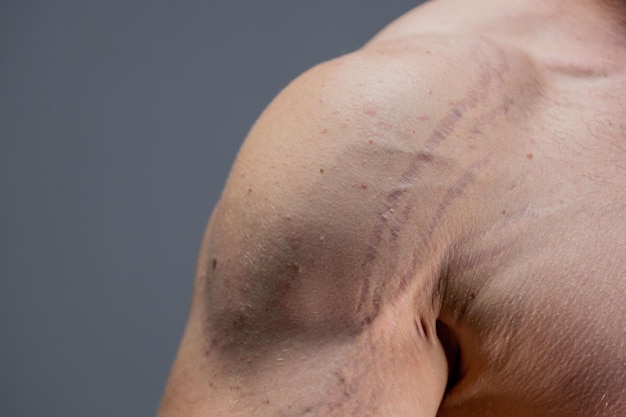 Photo stretch marks on the arm