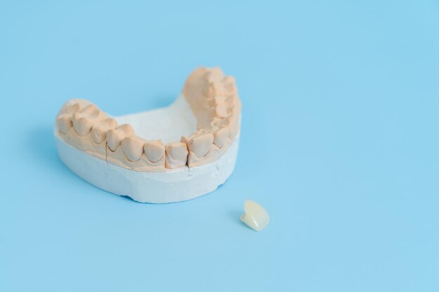 Study model of teeth and gums On blue background Dental concept