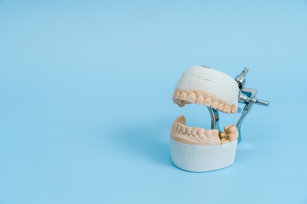 Study model of teeth and gums on blue background dental\
concept