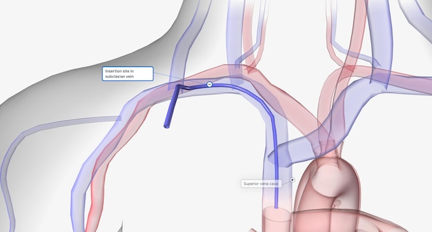 Foto la vena succlavia è uno dei siti più comuni utilizzati per il posizionamento di cvc