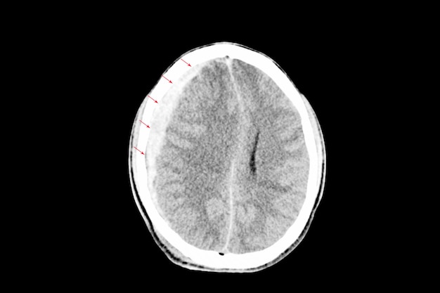 Subdurale bloeding met hersenoedeem